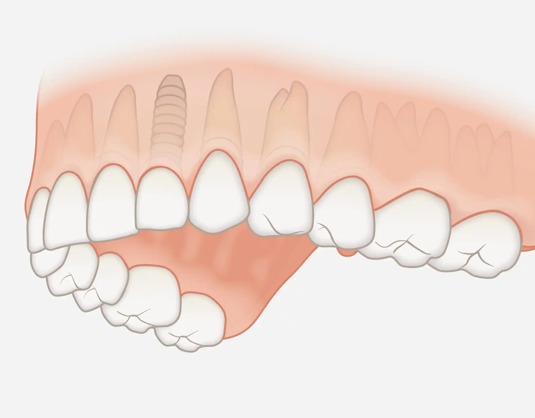 251013_einzelzahn_impl Einzelzahnersatz