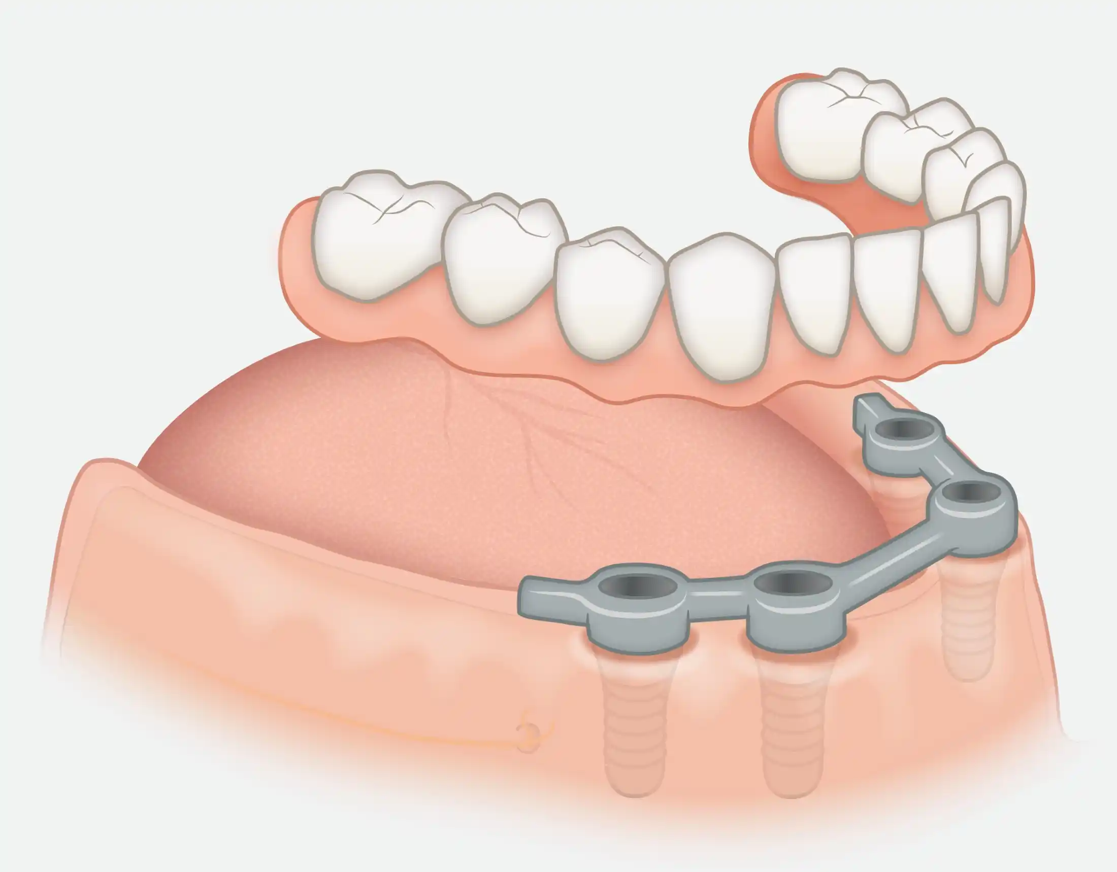 251016_UK_prothese_Steg