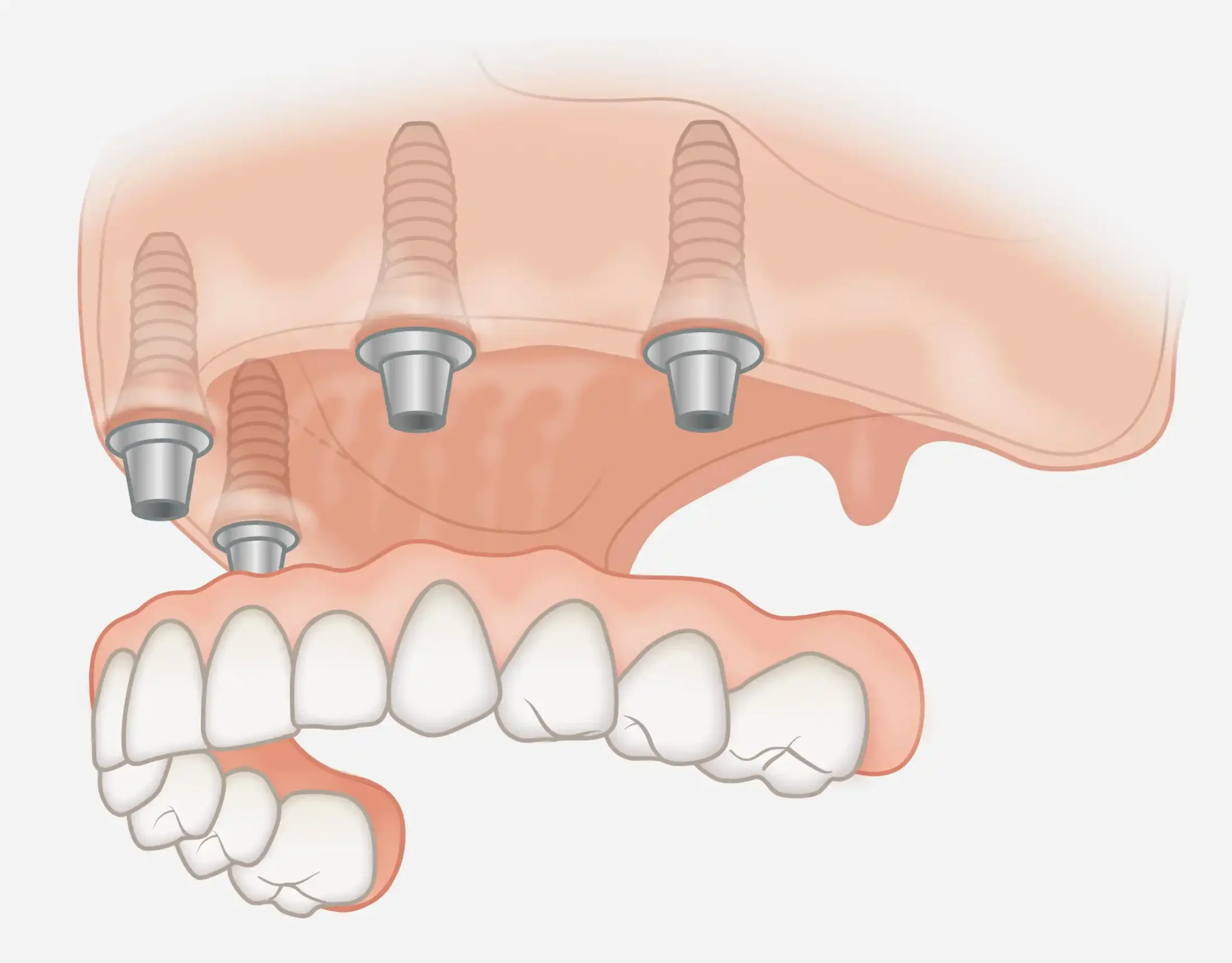 260402_OK_prothese_teleskop Abnehmbarer Zahnersatz Implantat