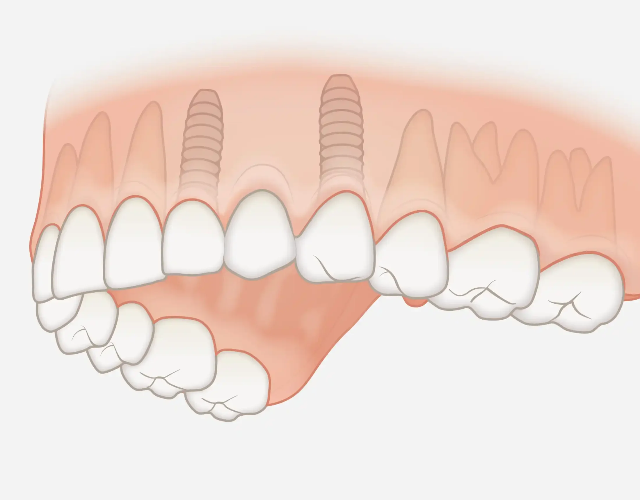 260402_bruecke_impl Zahngruppenersatz Implantat