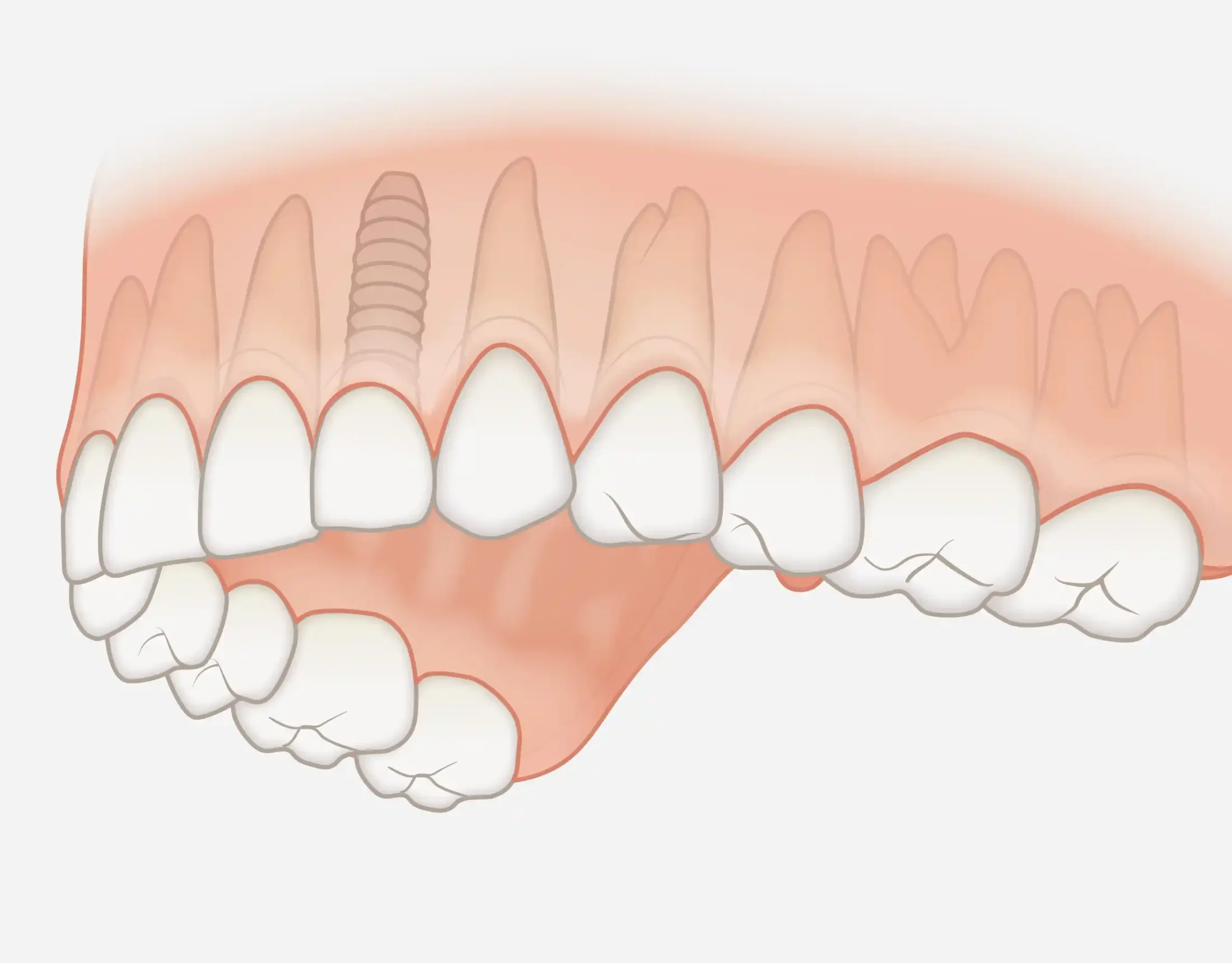 260402_einzelzahn_impl Einzelzahnersatz Implantat
