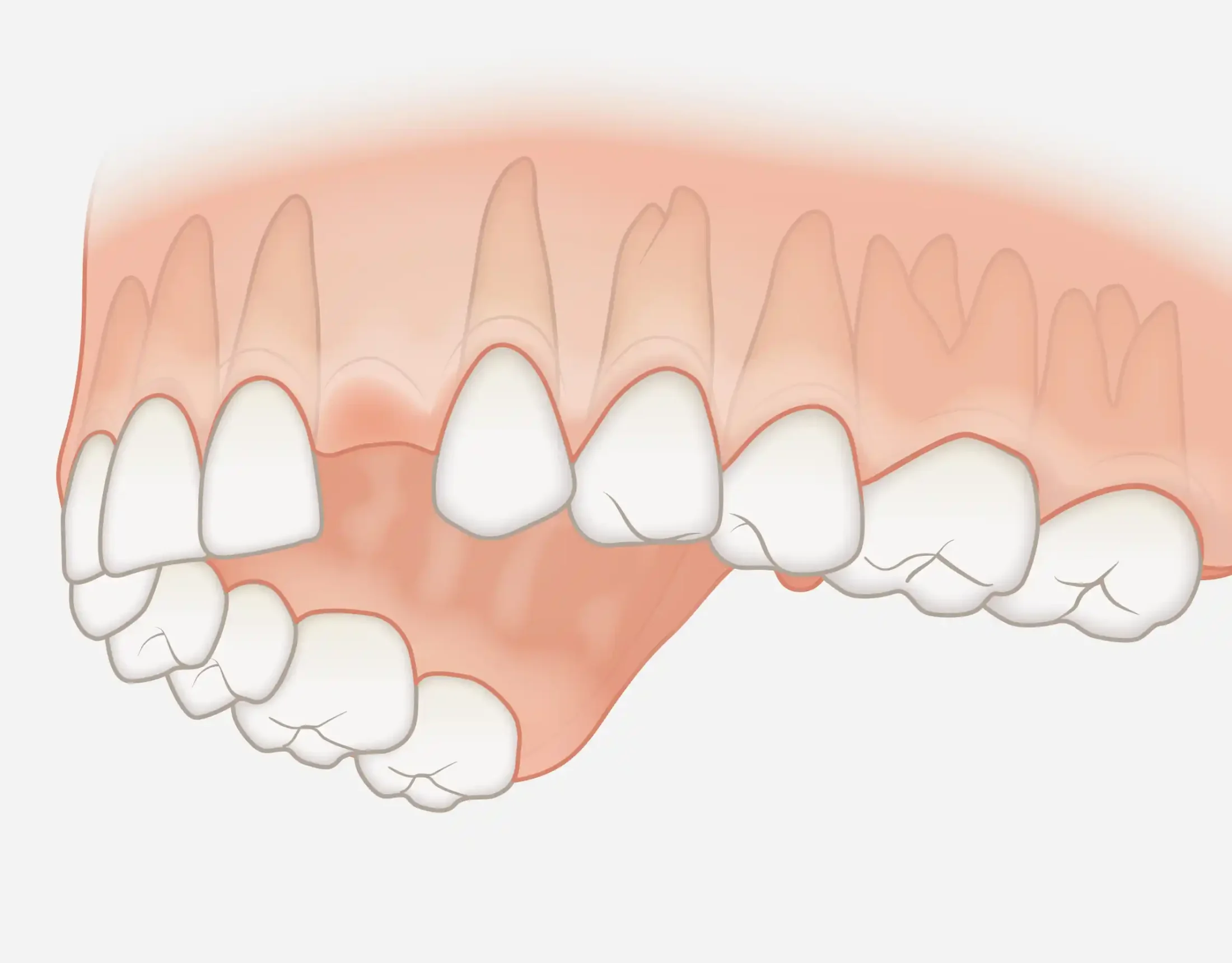 260402_einzelzahn_luecke Einzelzahnersatz