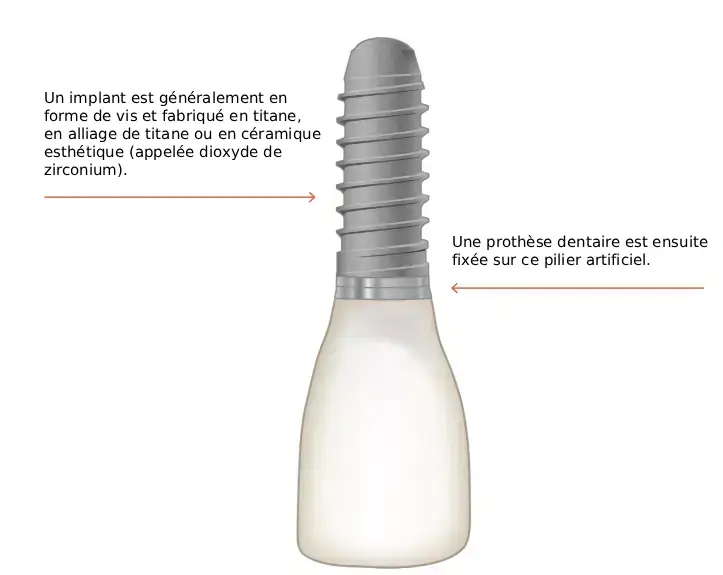 Implant